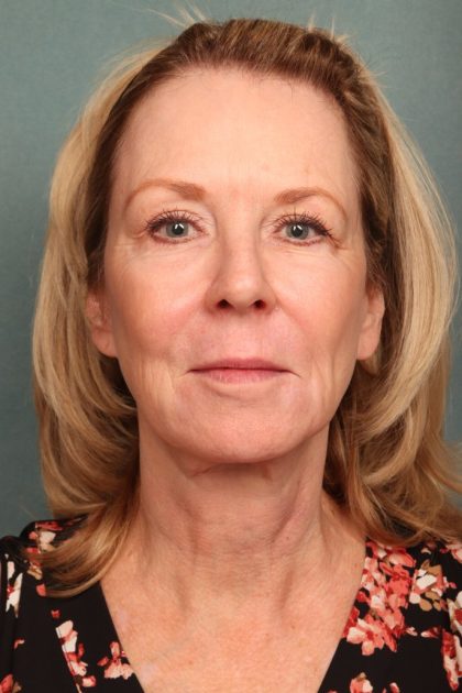 Chemical Peel Before & After Patient #10711
