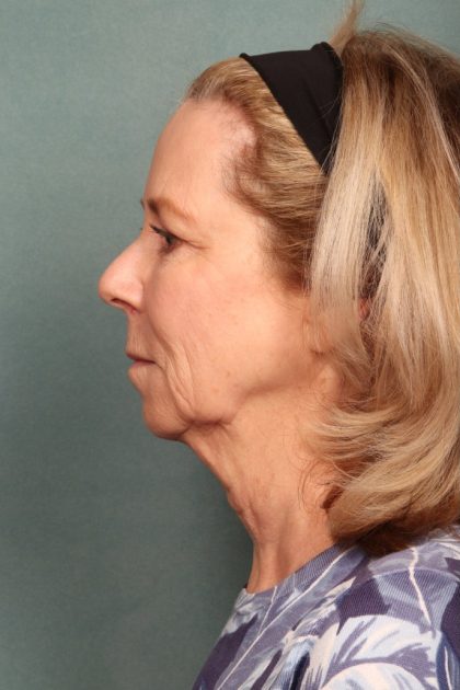 Chemical Peel Before & After Patient #10711