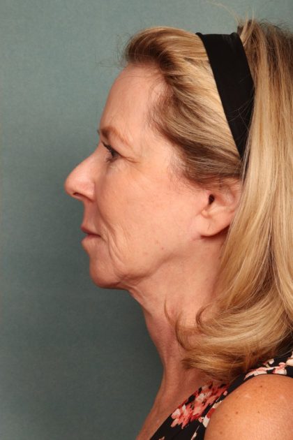 Chemical Peel Before & After Patient #10711