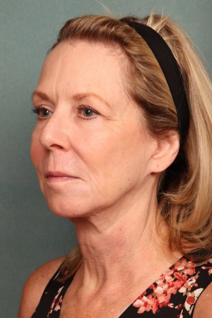 Chemical Peel Before & After Patient #10711