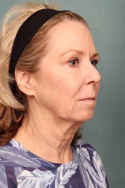 Chemical Peel Before & After Patient #10711