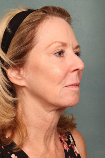 Chemical Peel Before & After Patient #10711
