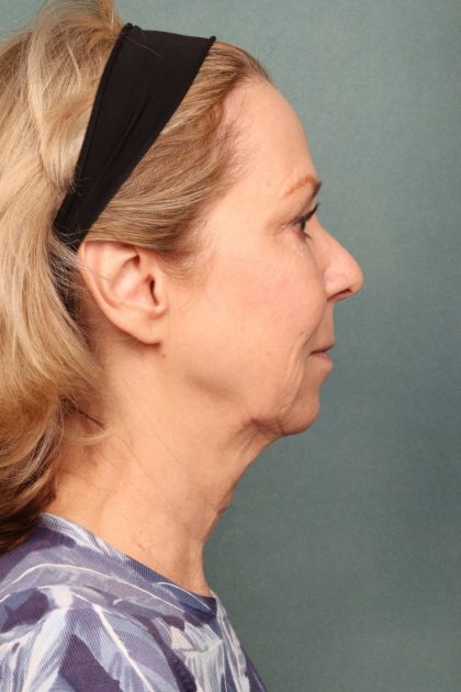 Chemical Peel Before & After Patient #10711