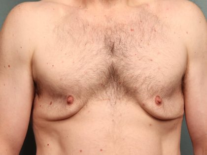 Gynecomastia Before & After Patient #10696