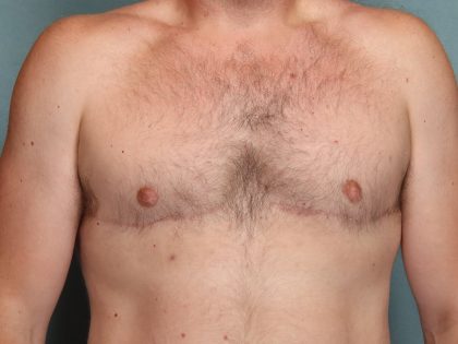 Gynecomastia Before & After Patient #10696