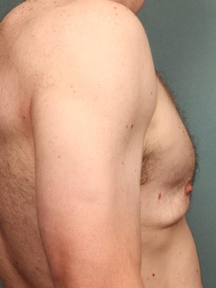 Gynecomastia Before & After Patient #10696