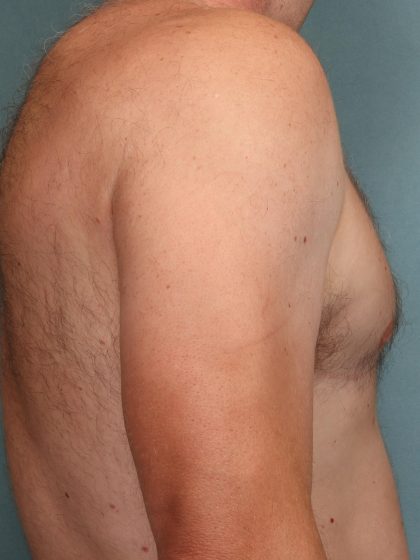 Gynecomastia Before & After Patient #10696