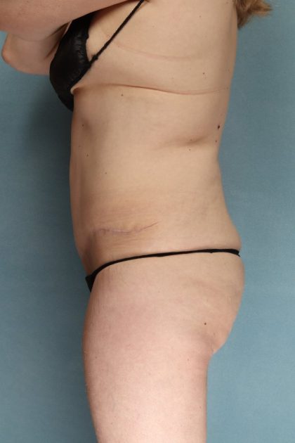 Tummy Tuck Before & After Patient #10702