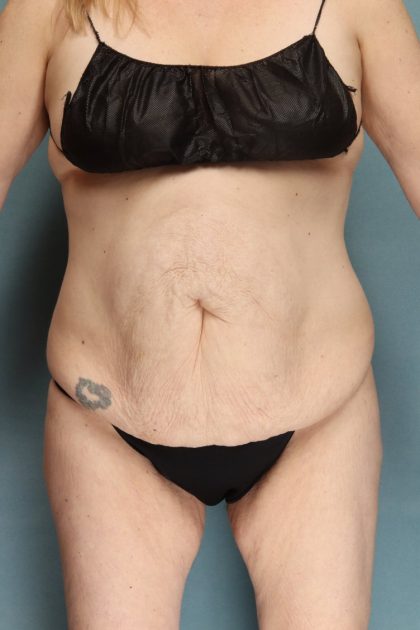 Tummy Tuck Before & After Patient #10702