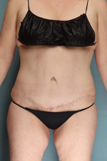 Tummy Tuck Before & After Patient #10702