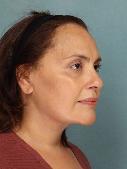 Facelift Before & After Patient #10725