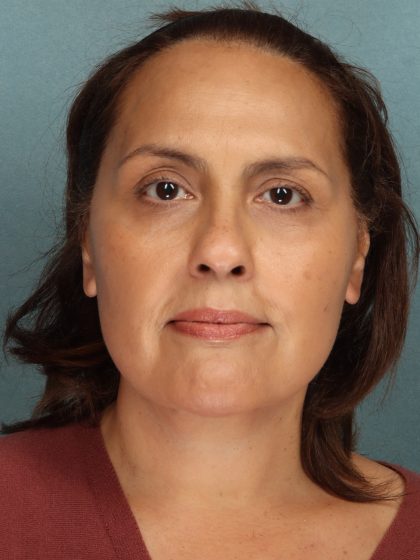 Facelift Before & After Patient #10725