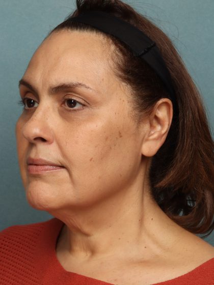 Facelift Before & After Patient #10725