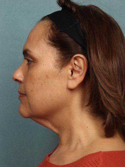 Facelift Before & After Patient #10725