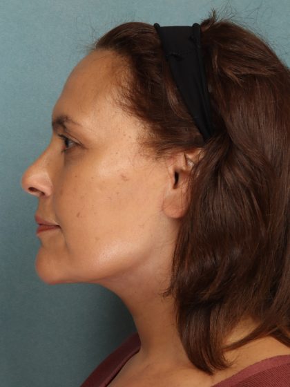 Facelift Before & After Patient #10725