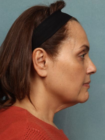 Facelift Before & After Patient #10725