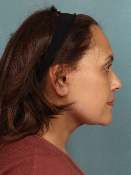 Facelift Before & After Patient #10725