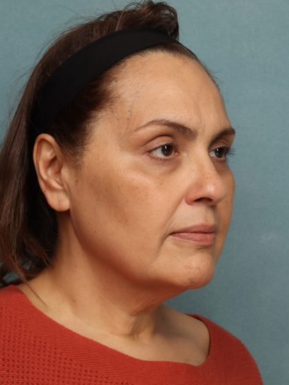 Facelift Before & After Patient #10725