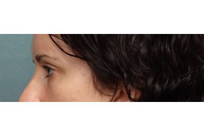 Brow Lift Before & After Patient #10749