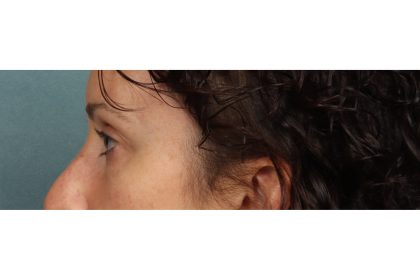 Brow Lift Before & After Patient #10749