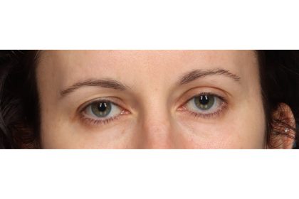 Brow Lift Before & After Patient #10749