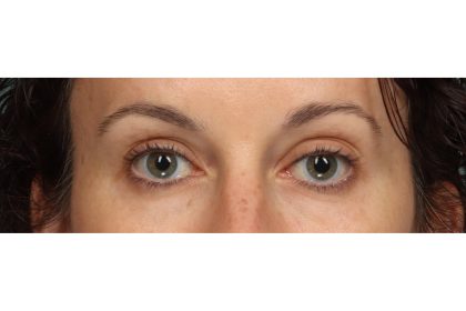 Brow Lift Before & After Patient #10749